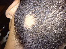 Alopecia Areata Santa Monica