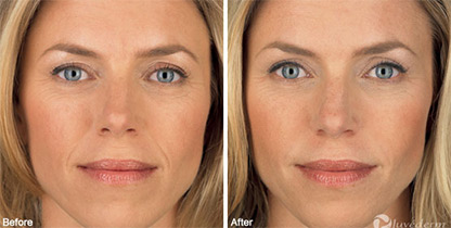 Juvederm Los Angeles