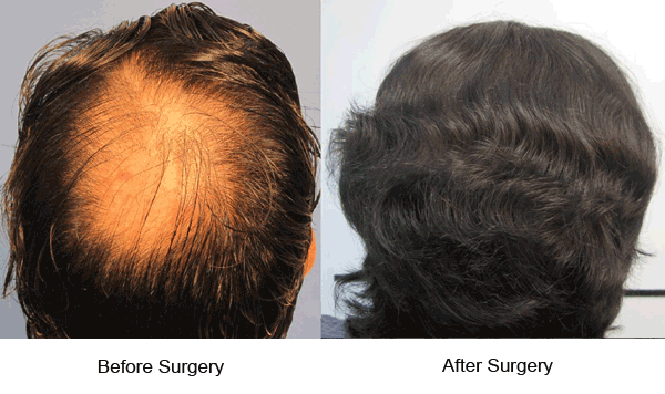 Hair Transplant - Incredible Hair Transplant Surgery Results!