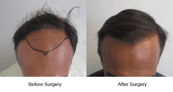 hair transplant LA