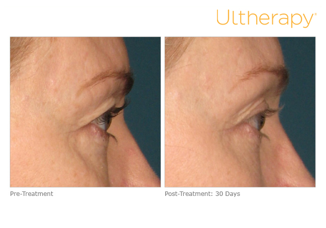 ultherapy-000k-004y_before-30daysafter_brow