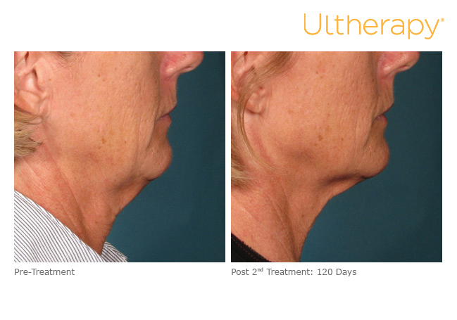Ultherapy before and after photo