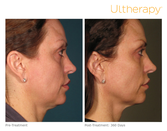 ultherapy-000p-015y_before-360daysafter_full