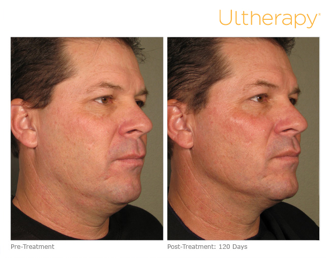 ultherapy-0058d_before-120daysafter_full