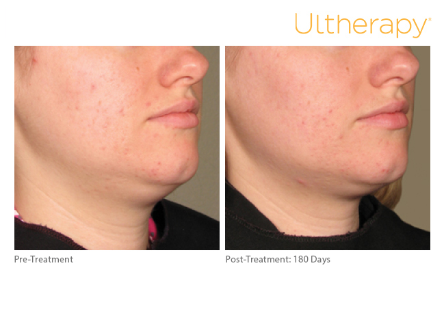 ultherapy-0088j-e_before-180daysafter_lower_low-res