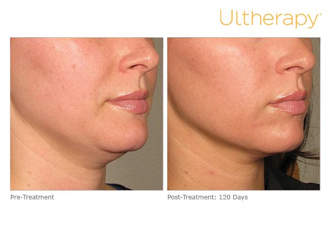 ultherapy-0132p-h_before-120daysafter_lower_low-res
