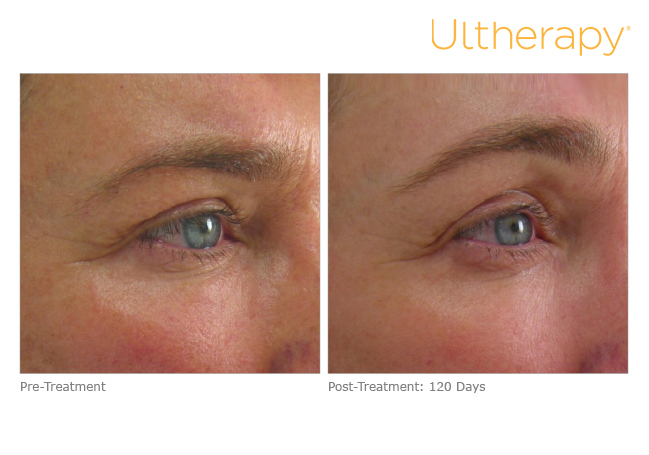 Ultherapy before and after photo