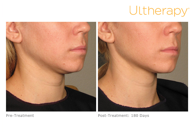 ultherapy-p011_before-180daysafter_lower