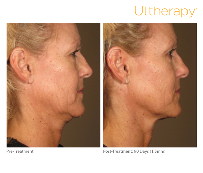 ultherapy15mm-0297j-k_before-90daysafter_full