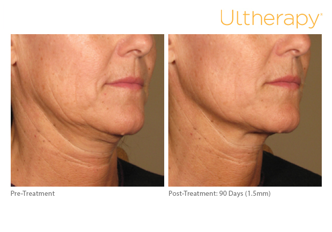 ultherapy15mm-0297j-k_before-90daysafter_lower2_low-res