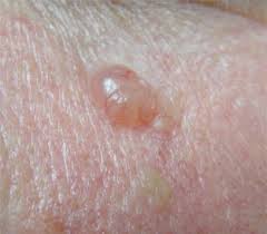 Basal cell skin cancer