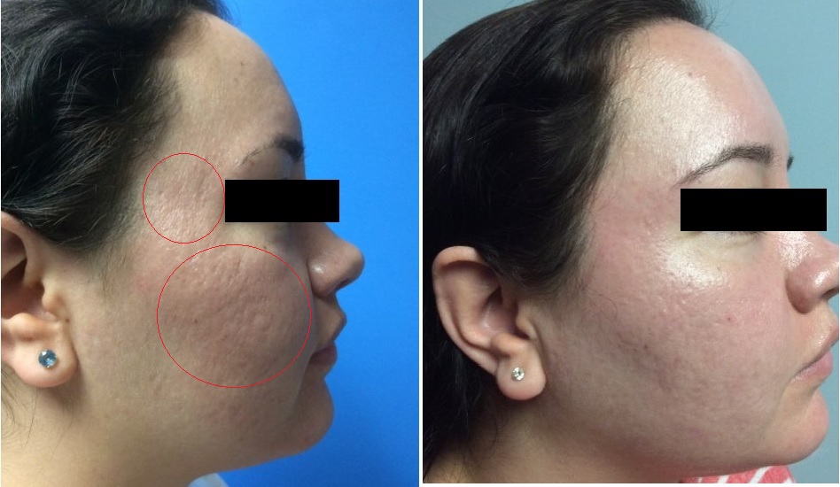 100 Tca Peel For Acne Scars | informacionpublica.svet.gob.gt