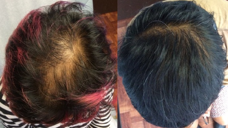 Stem cell for hair loss before and after
