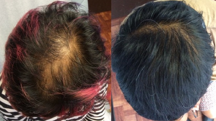 Male Stem Cell Therapy For Hair Regrowth