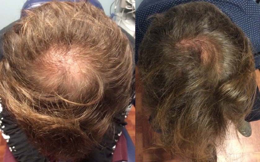 Stem cell for hair loss before and after