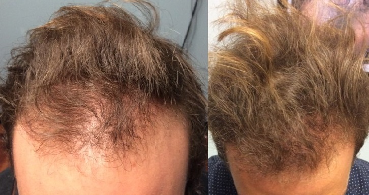 Stem Cell Therapy - Hair Restoration Clinic - The Hair Loss Doctors