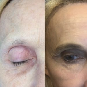 Stem cells for eyebrows before and after on woman