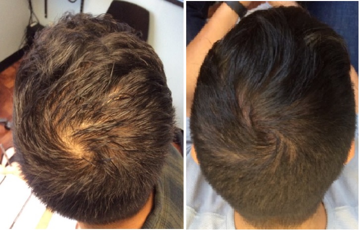 Relevant Images Gallery About of Topical Finasteride Minoxidil Essengen.