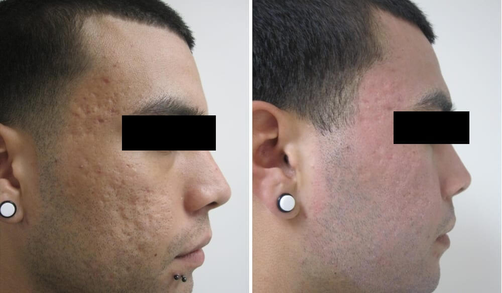 Before and after of acne scars on male