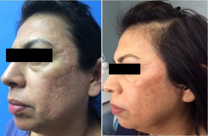 Before and after of acne scars on woman