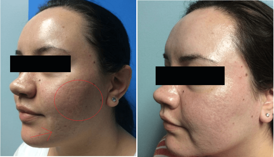 Before and after of acne scars on woman