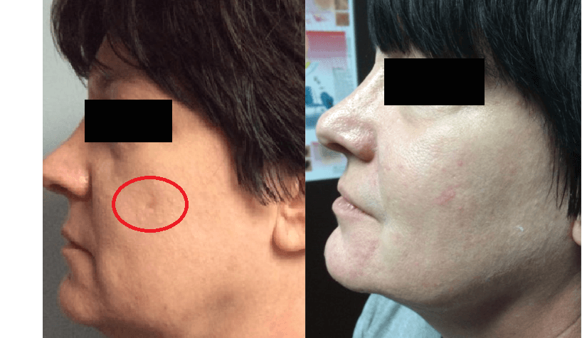 Before and after of acne scars on woman