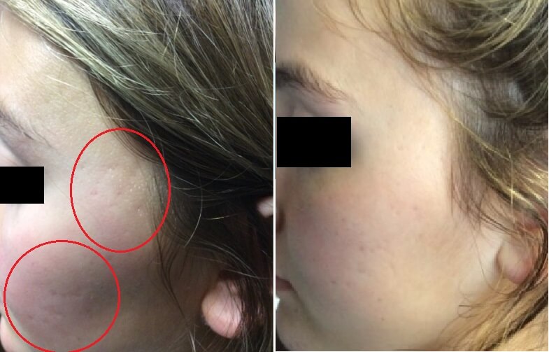 Before and after of acne scars on woman