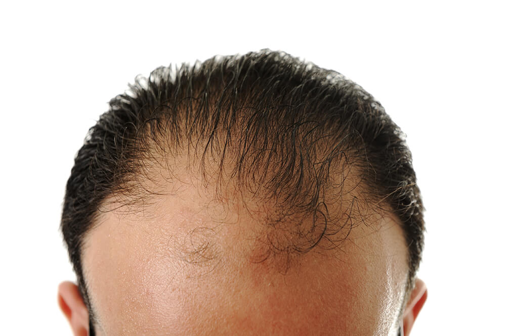 PRP Los Angeles - Platelet-Rich Plasma - PRP Treatment for Hair Loss