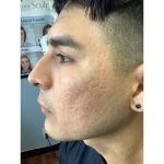 Man with acne scars on the left side of the face