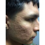 Man with acne scars on the right side of the face