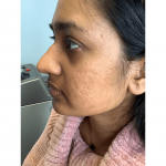 Woman with acne scars on the left side of the face