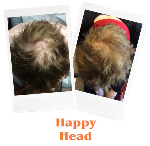 Topical finasteride Happy Head before and after