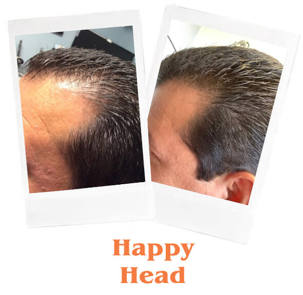 Topical finasteride Happy Head before and after