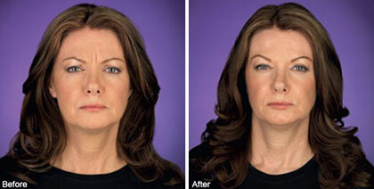 Botox before and after