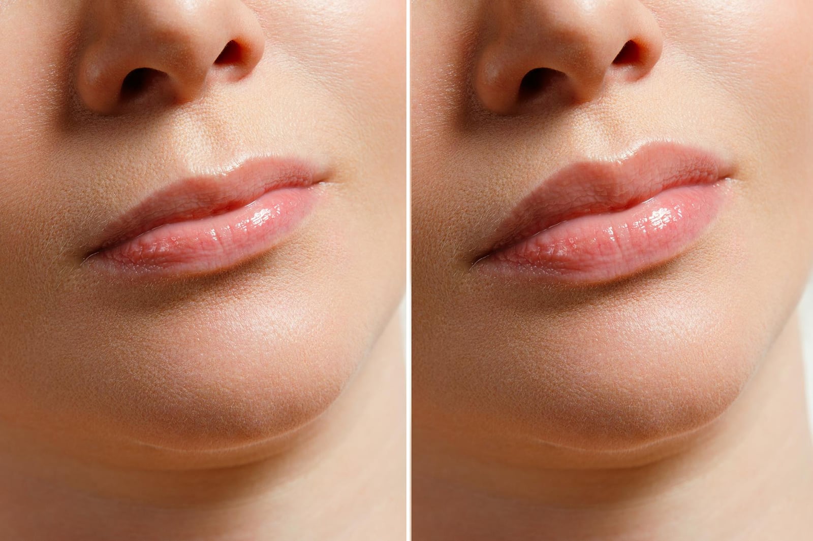 Lip Fillers Los Angeles Natural Lip Filler Injections
