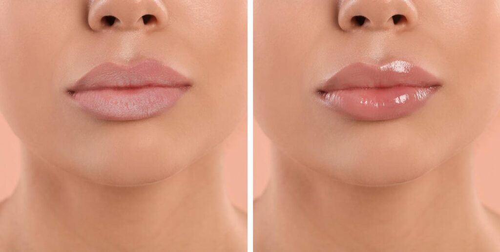 Lip augmentation before and after transformation