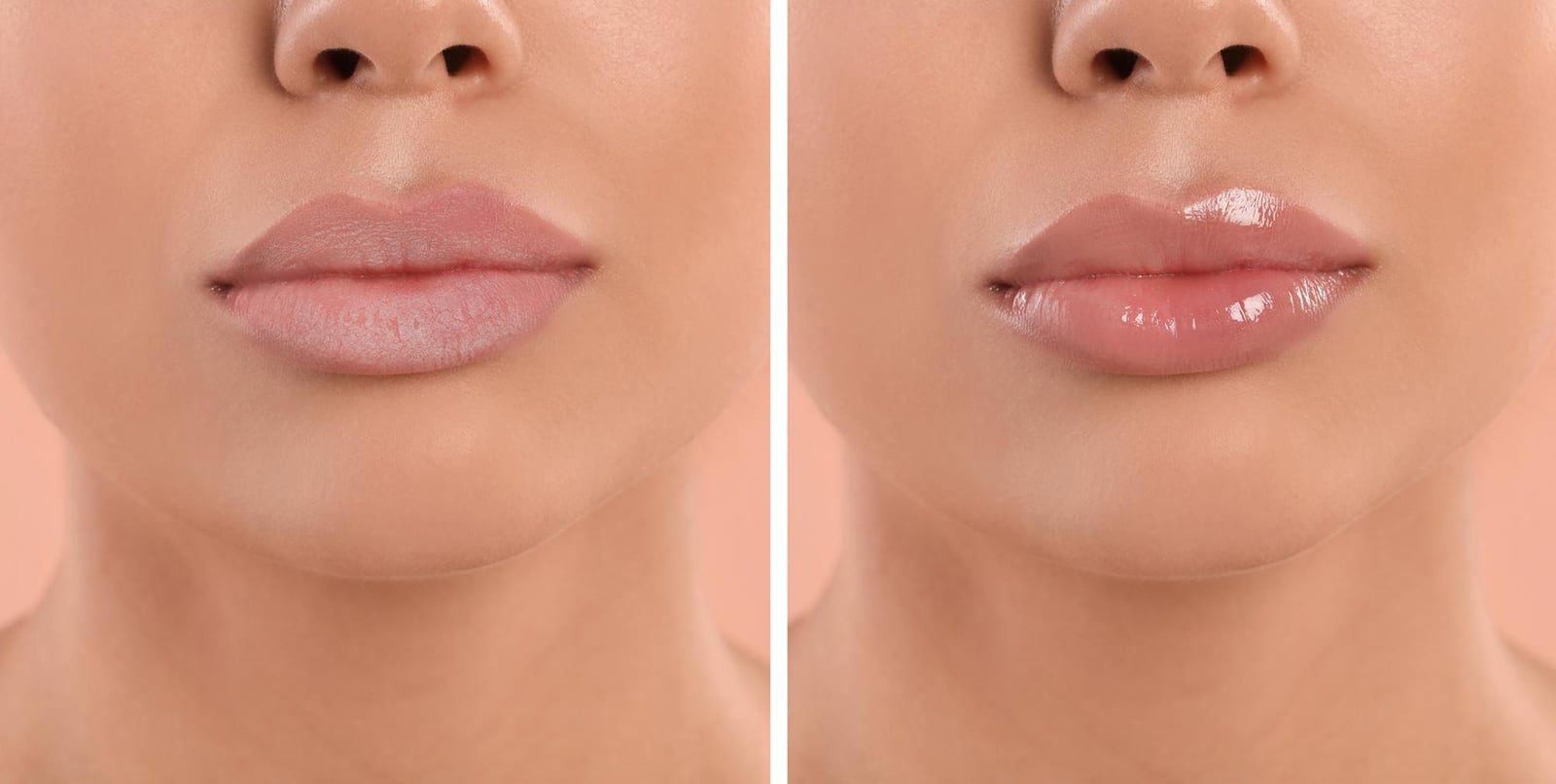 Lip Fillers Los Angeles Natural Lip Filler Injections