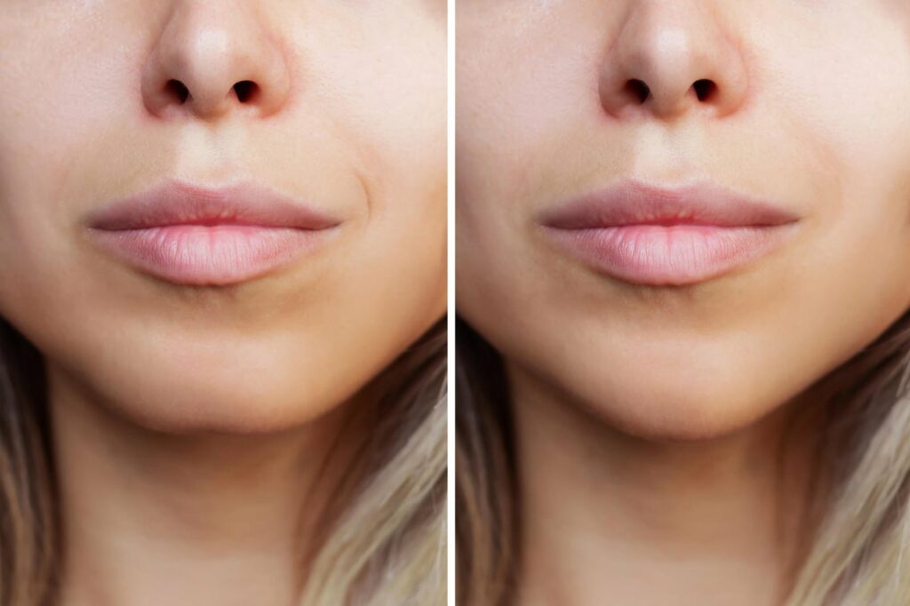 Lip injections before and after transformation