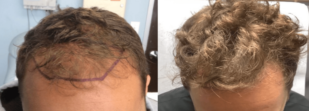 Before and after stem cell therapy treatment in Los Angeles - Dr. Ben Behnam
