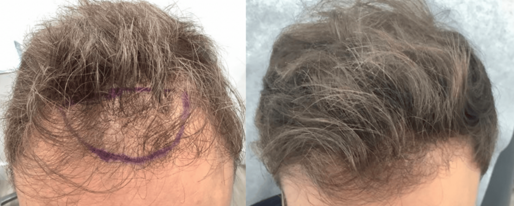 Before and after stem cell therapy treatment in Los Angeles - Dr. Ben Behnam