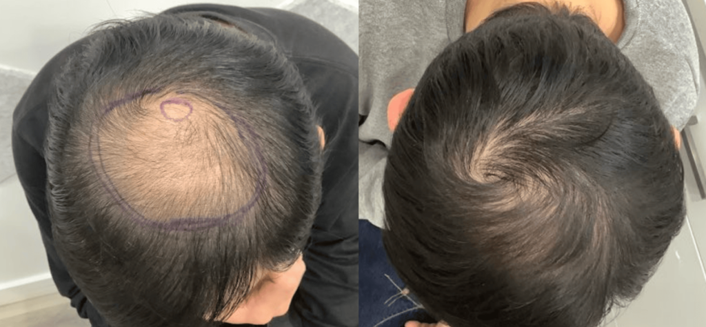 Before and after stem cell therapy treatment in Los Angeles - Dr. Ben Behnam
