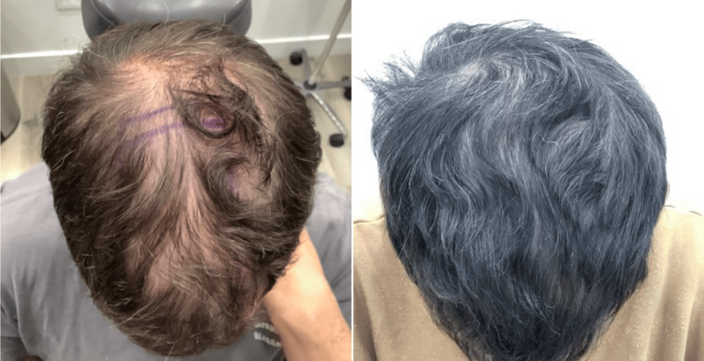 Before and after stem cell therapy treatment in Los Angeles - Dr. Ben Behnam